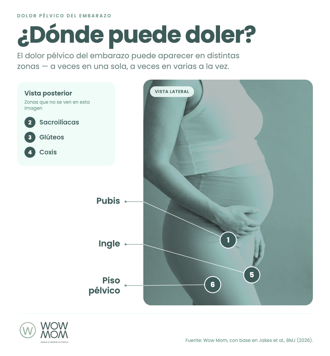 Infografía: ¿Dónde puede doler? Mapa anatómico de zonas de dolor pélvico durante el embarazo